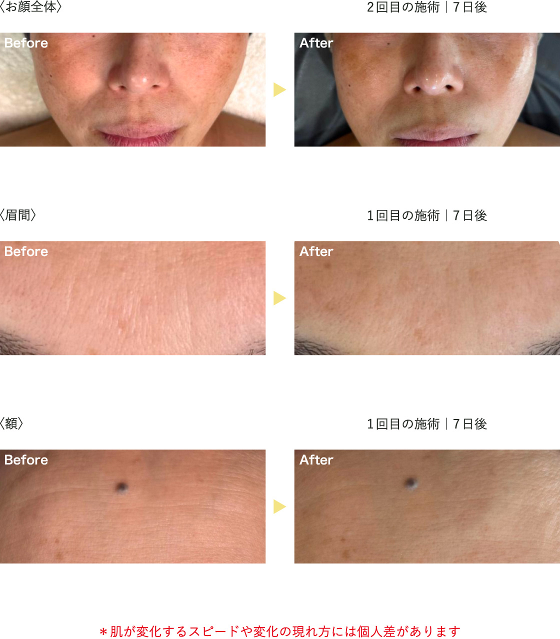 
                            before after 写真
                            ＊肌が変化するスピードや変化の現れ方には個人差があります
                        